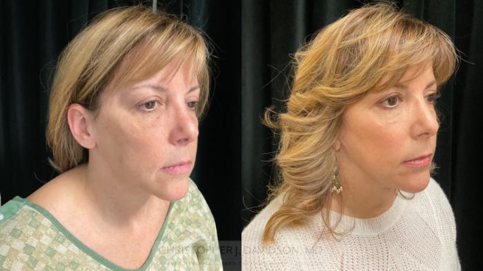 Facelift Surgery Case 395 Before & After Right Oblique | Boston, MA | Christopher J. Davidson, MD