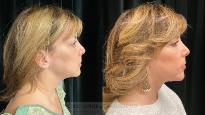 Facelift Surgery Case 395 Before & After Right Side | Boston, MA | Christopher J. Davidson, MD