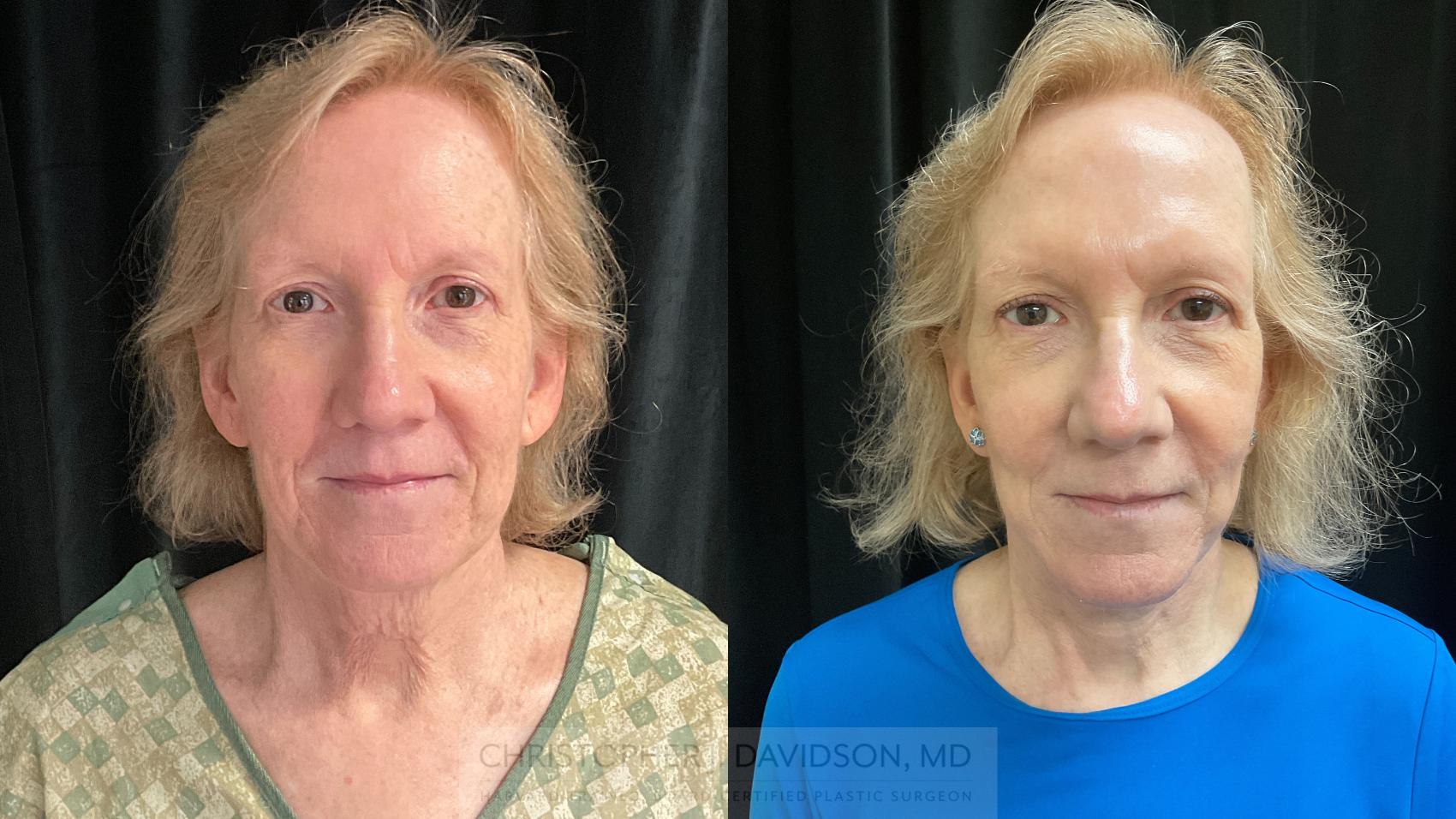 Facelift Surgery Case 396 Before & After Front | Boston, MA | Christopher J. Davidson, MD