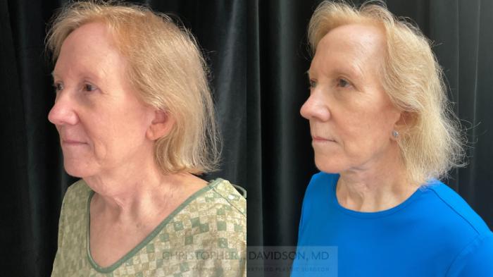 Facelift Surgery Case 396 Before & After Left Oblique | Boston, MA | Christopher J. Davidson, MD