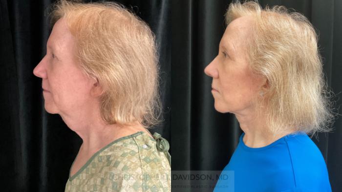 Facelift Surgery Case 396 Before & After Left Side | Boston, MA | Christopher J. Davidson, MD