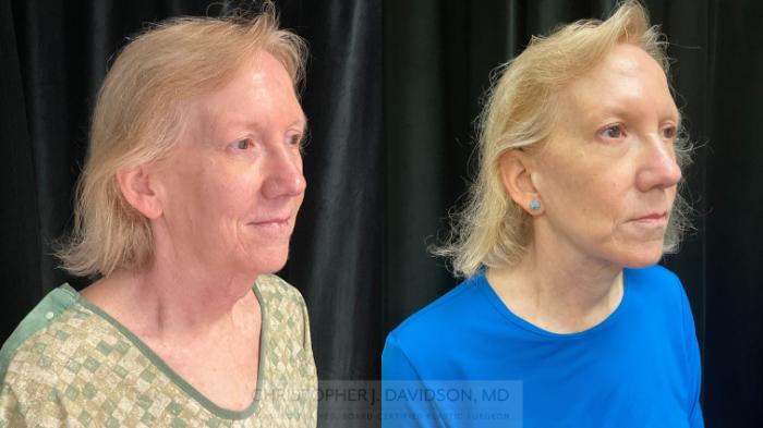 Facelift Surgery Case 396 Before & After Right Oblique | Boston, MA | Christopher J. Davidson, MD