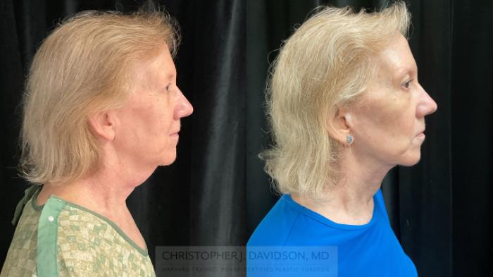 Facelift Surgery Case 396 Before & After Right Side | Boston, MA | Christopher J. Davidson, MD