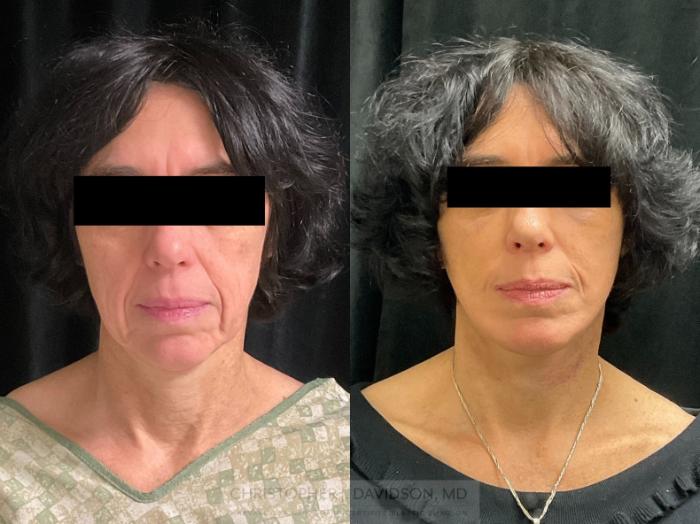 Facelift Surgery Case 410 Before & After Front | Boston, MA | Christopher J. Davidson, MD