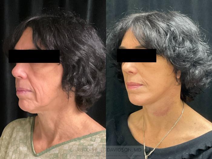 Facelift Surgery Case 410 Before & After Left Oblique | Boston, MA | Christopher J. Davidson, MD