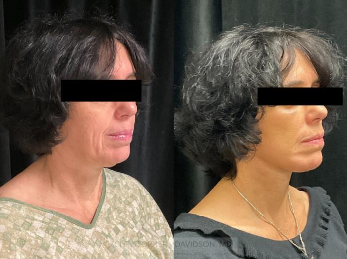 Facelift Surgery Case 410 Before & After Right Oblique | Boston, MA | Christopher J. Davidson, MD