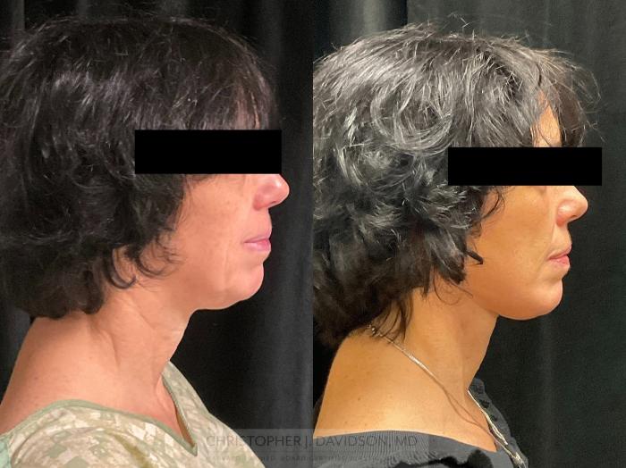 Facelift Surgery Case 410 Before & After Right Side | Boston, MA | Christopher J. Davidson, MD