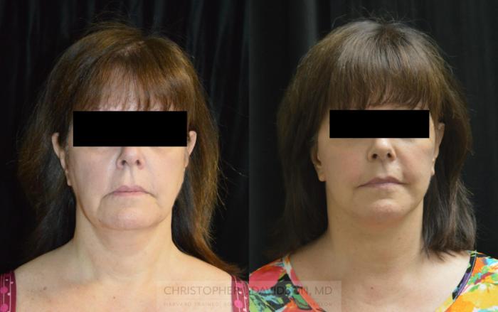 Facelift Surgery Case 439 Before & After Front | Boston, MA | Christopher J. Davidson, MD