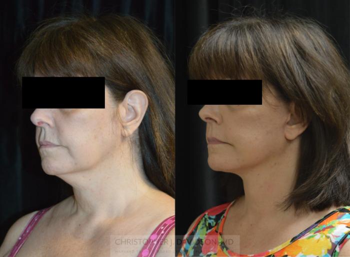 Facelift Surgery Case 439 Before & After Left Oblique | Boston, MA | Christopher J. Davidson, MD