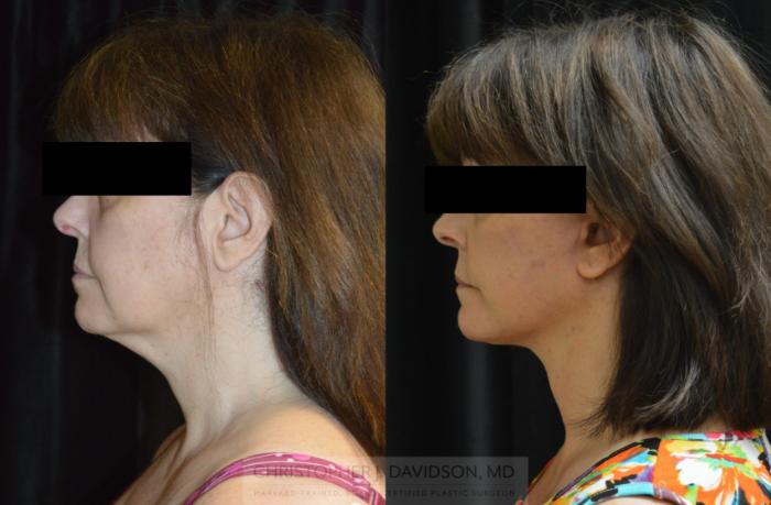 Facelift Surgery Case 439 Before & After Left Side | Boston, MA | Christopher J. Davidson, MD