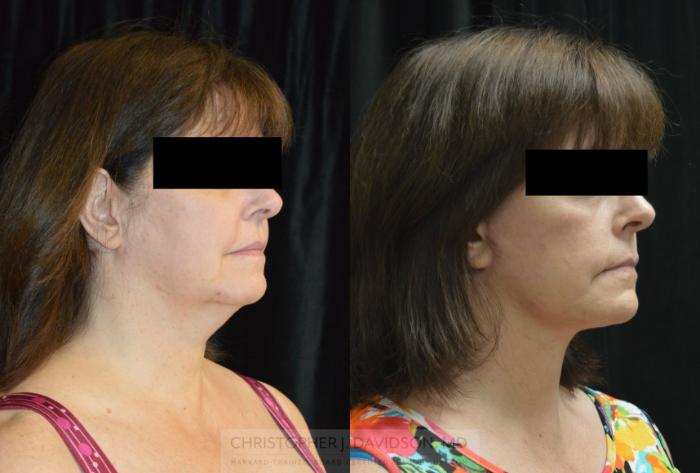 Facelift Surgery Case 439 Before & After Right Oblique | Boston, MA | Christopher J. Davidson, MD