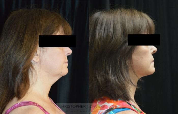 Facelift Surgery Case 439 Before & After Right Side | Boston, MA | Christopher J. Davidson, MD