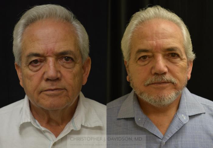 Facelift Surgery Case 444 Before & After Front | Boston, MA | Christopher J. Davidson, MD