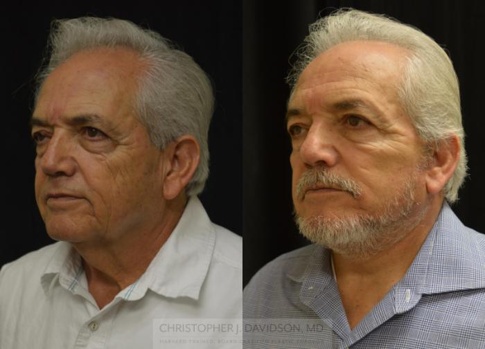 Facelift Surgery Case 444 Before & After Left Oblique | Boston, MA | Christopher J. Davidson, MD