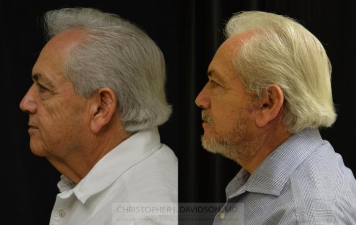 Facelift Surgery Case 444 Before & After Left Side | Boston, MA | Christopher J. Davidson, MD
