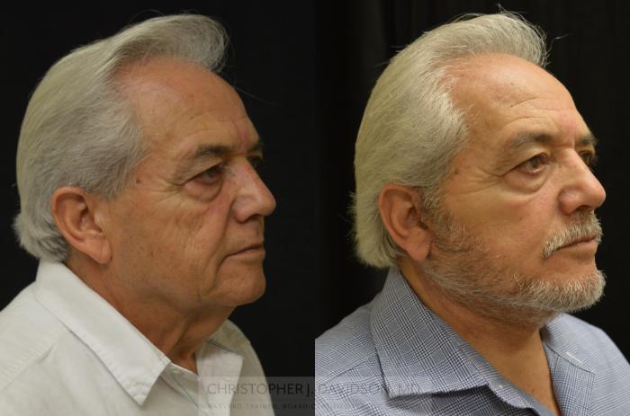 Facelift Surgery Case 444 Before & After Right Oblique | Boston, MA | Christopher J. Davidson, MD