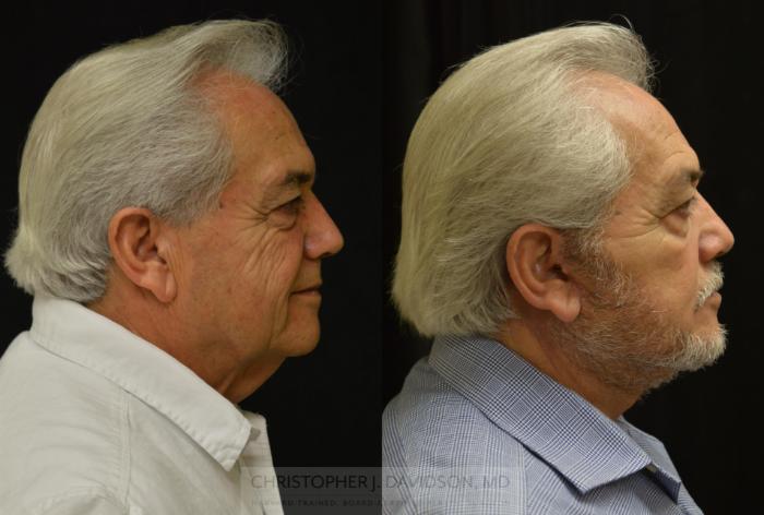 Facelift Surgery Case 444 Before & After Right Side | Boston, MA | Christopher J. Davidson, MD