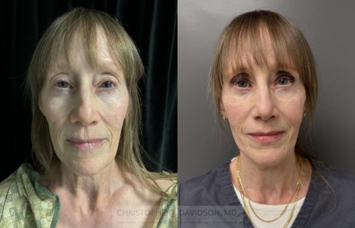 Facelift Surgery Case 453 Before & After Front | Boston, MA | Christopher J. Davidson, MD