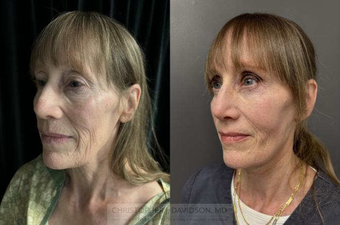 Facelift Surgery Case 453 Before & After Left Oblique | Boston, MA | Christopher J. Davidson, MD