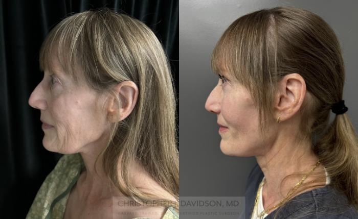 Facelift Surgery Case 453 Before & After Left Side | Boston, MA | Christopher J. Davidson, MD