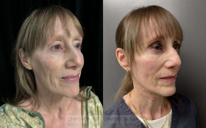 Facelift Surgery Case 453 Before & After Right Oblique | Boston, MA | Christopher J. Davidson, MD