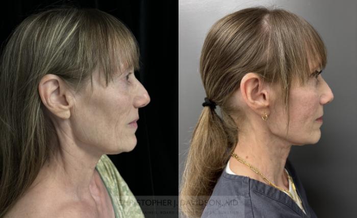 Facelift Surgery Case 453 Before & After Right Side | Boston, MA | Christopher J. Davidson, MD