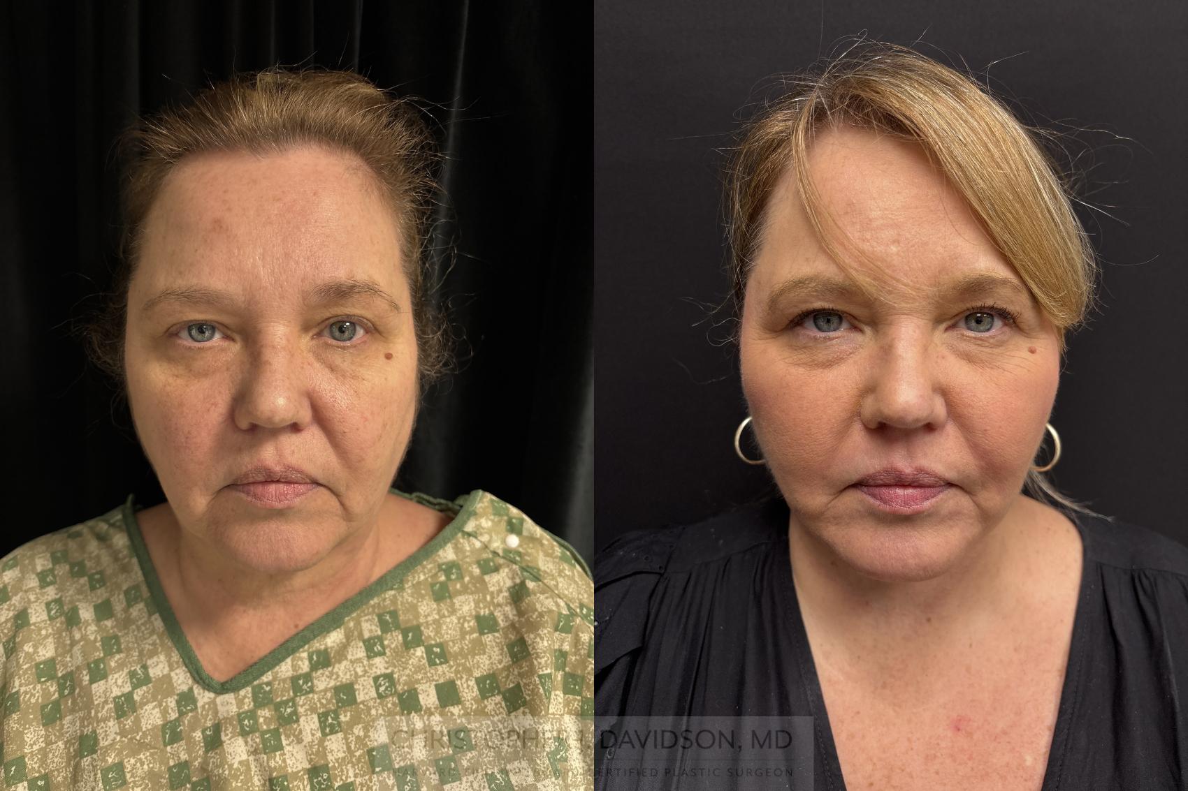 Facelift Surgery Case 466 Before & After Front | Boston, MA | Christopher J. Davidson, MD