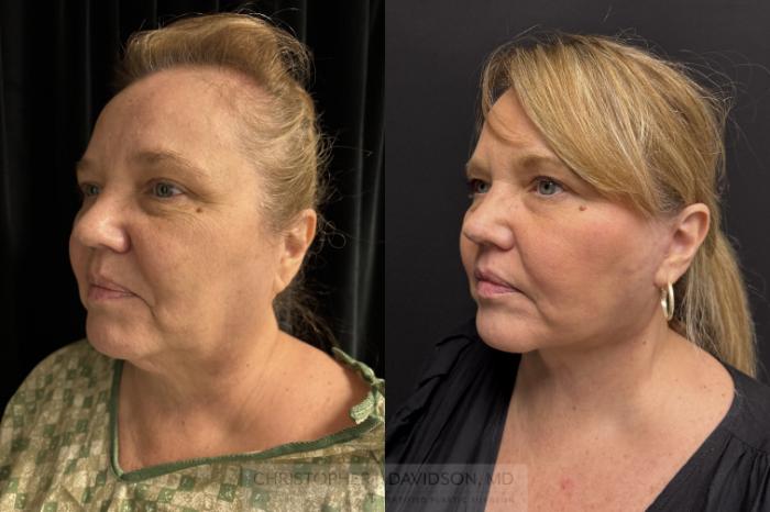Facelift Surgery Case 466 Before & After Left Oblique | Boston, MA | Christopher J. Davidson, MD