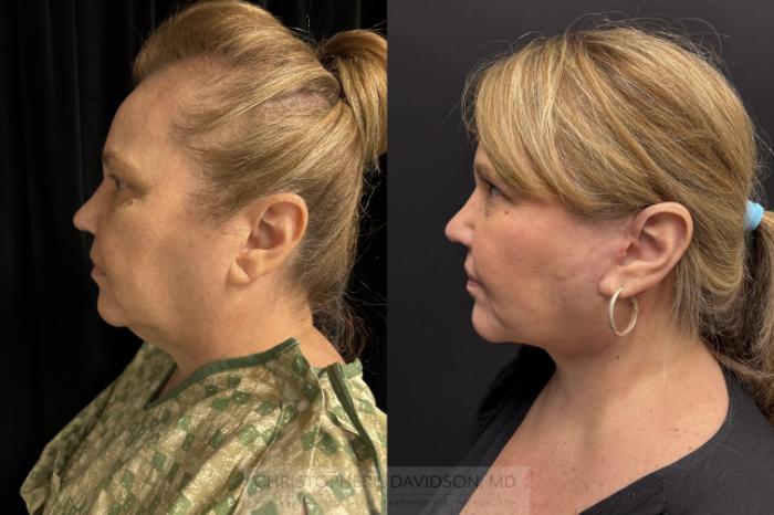 Facelift Surgery Case 466 Before & After Left Side | Boston, MA | Christopher J. Davidson, MD