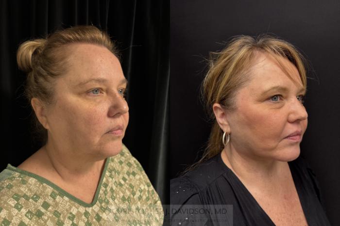 Facelift Surgery Case 466 Before & After Right Oblique | Boston, MA | Christopher J. Davidson, MD