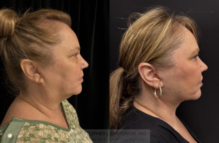 Facelift Surgery Case 466 Before & After Right Side | Boston, MA | Christopher J. Davidson, MD
