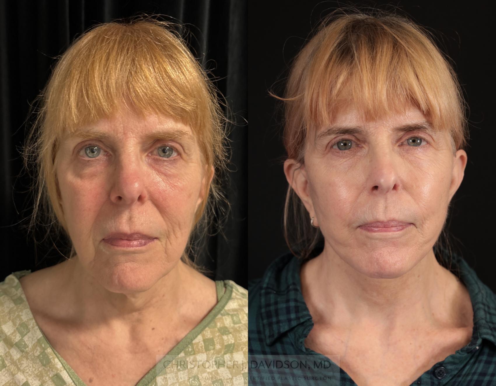 Facelift Surgery Case 470 Before & After Front | Boston, MA | Christopher J. Davidson, MD