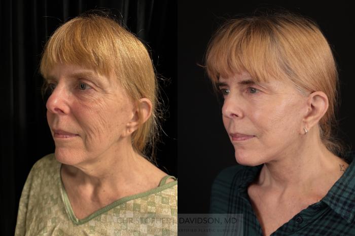 Facelift Surgery Case 470 Before & After Left Oblique | Boston, MA | Christopher J. Davidson, MD