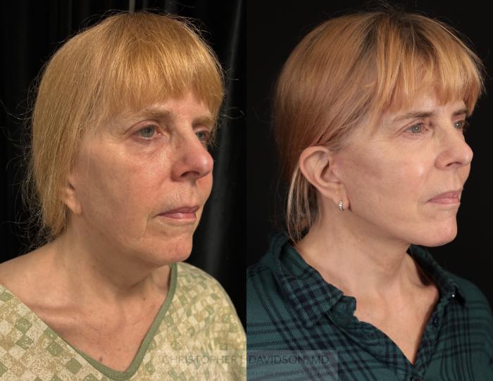 Facelift Surgery Case 470 Before & After Right Oblique | Boston, MA | Christopher J. Davidson, MD