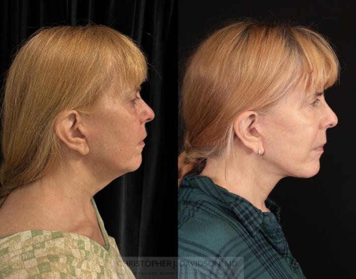 Facelift Surgery Case 470 Before & After Right Side | Boston, MA | Christopher J. Davidson, MD