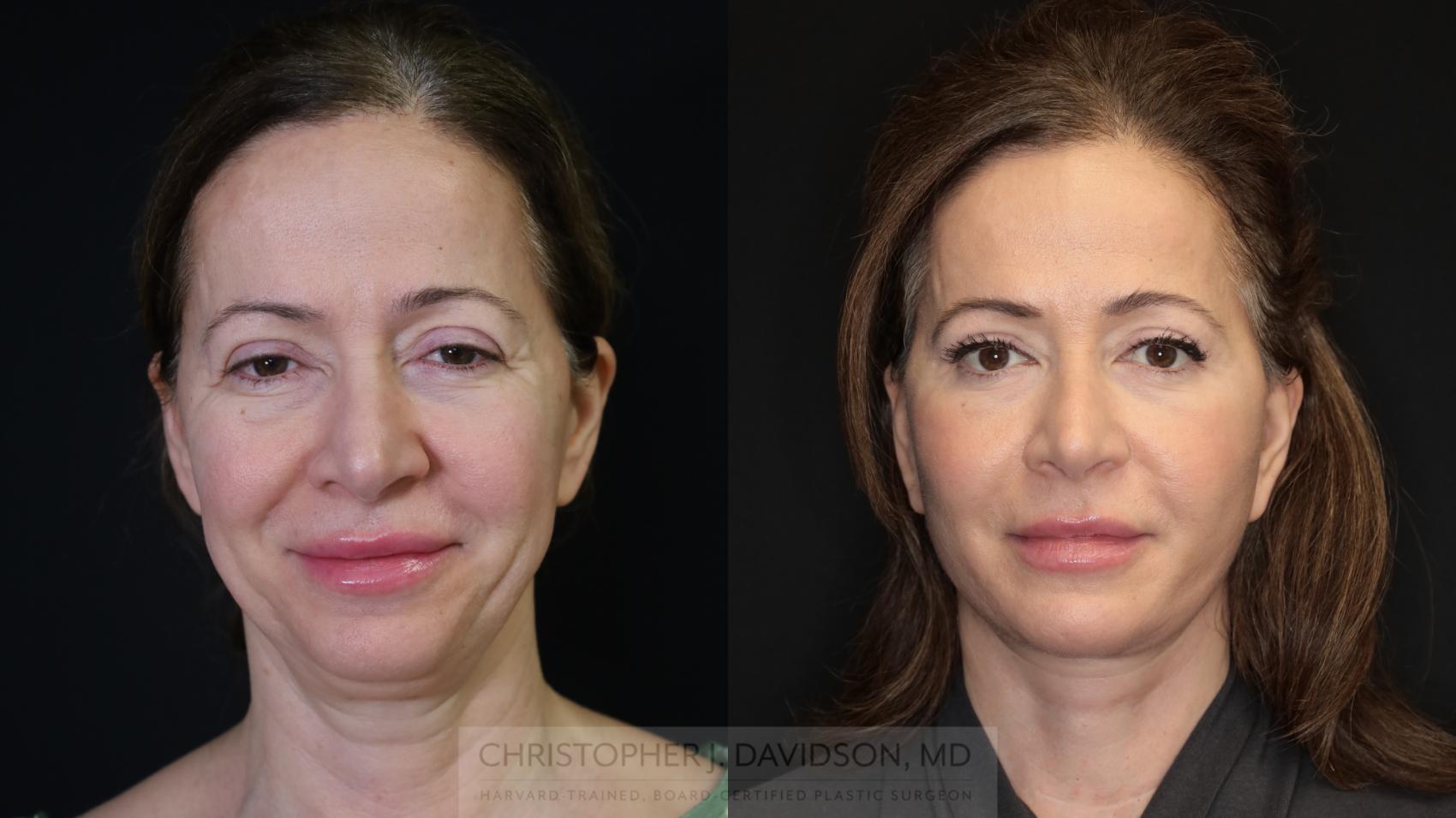 Facelift Surgery Case 491 Before & After Front | Boston, MA | Christopher J. Davidson, MD