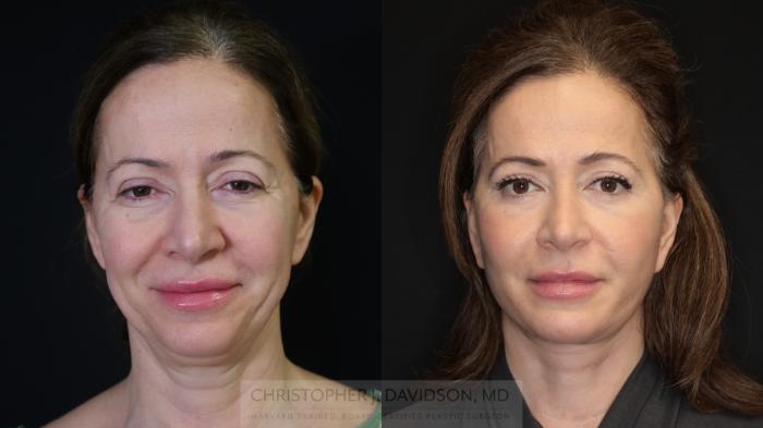 Facelift Surgery Case 491 Before & After Front | Boston, MA | Christopher J. Davidson, MD