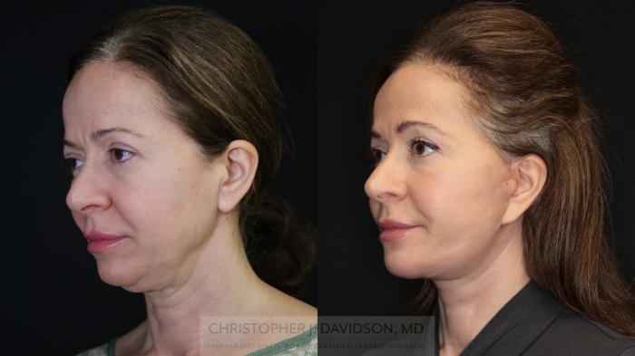 Facelift Surgery Case 491 Before & After Left Oblique | Boston, MA | Christopher J. Davidson, MD