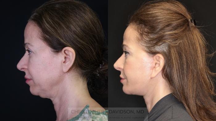 Facelift Surgery Case 491 Before & After Left Side | Boston, MA | Christopher J. Davidson, MD