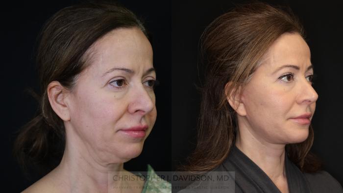 Facelift Surgery Case 491 Before & After Right Oblique | Boston, MA | Christopher J. Davidson, MD