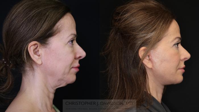 Facelift Surgery Case 491 Before & After Right Side | Boston, MA | Christopher J. Davidson, MD