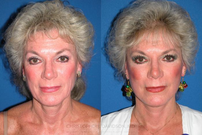 Facelift Surgery Case 7 Before & After View #1 | Boston, MA | Christopher J. Davidson, MD