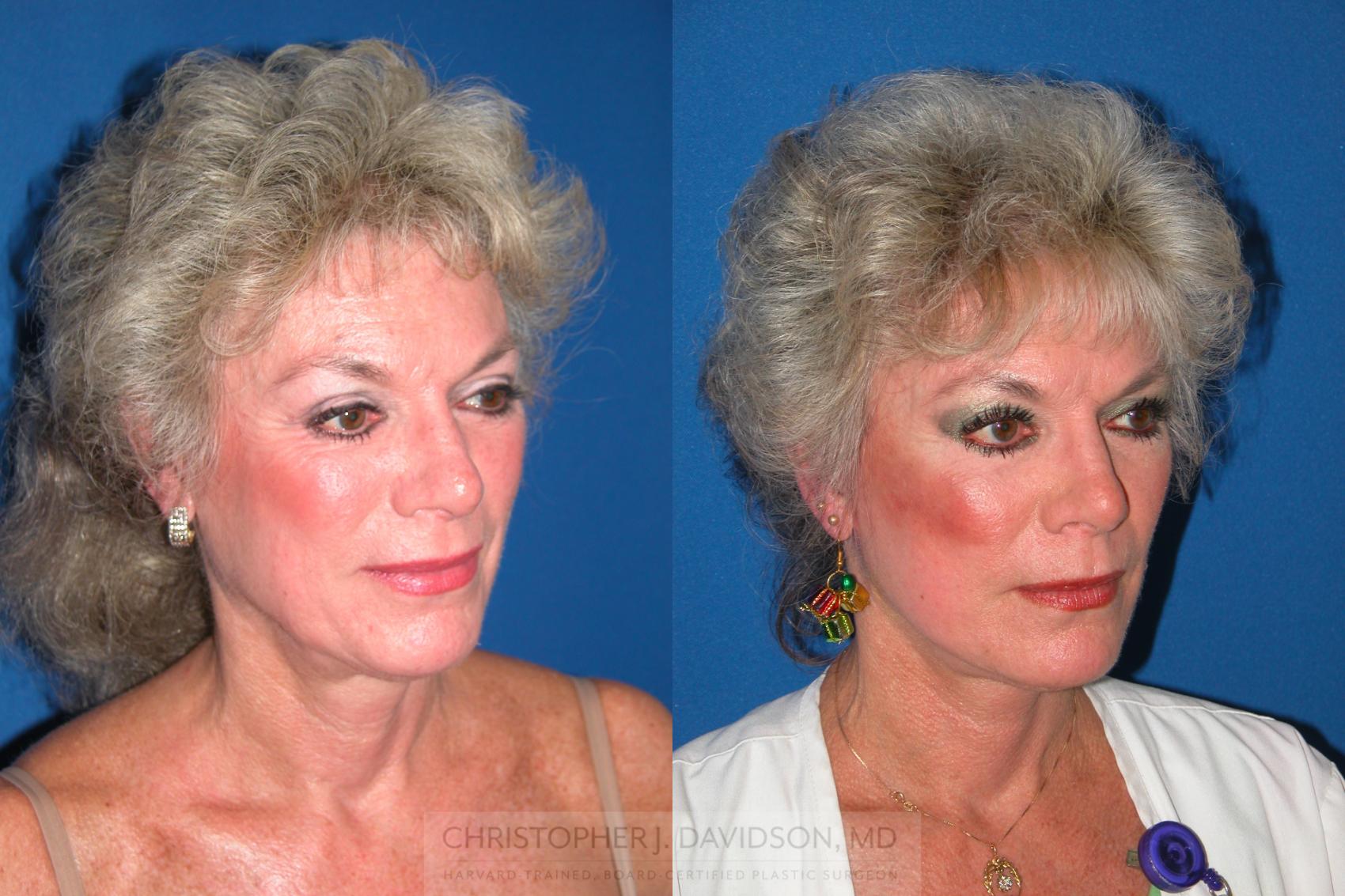 Facelift Surgery Case 7 Before & After View #3 | Wellesley, MA | Christopher J. Davidson, MD