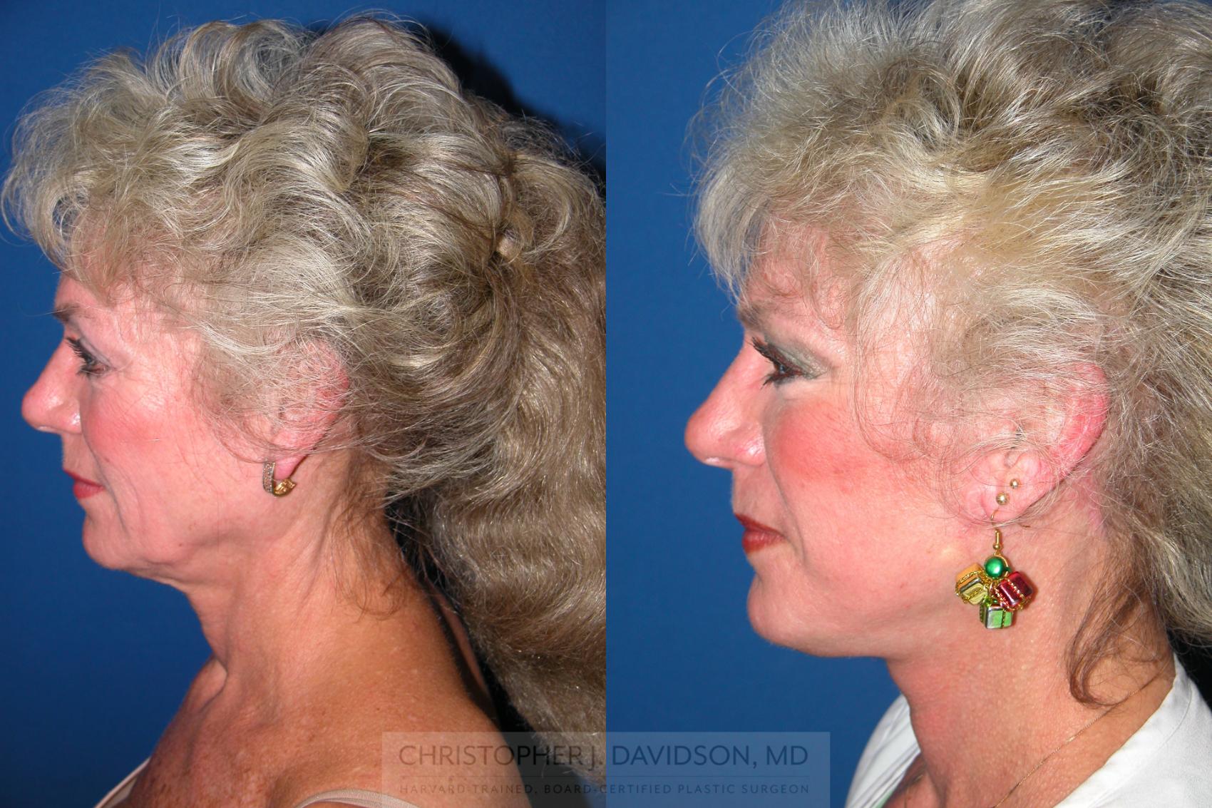 Facelift Surgery Case 7 Before & After View #4 | Wellesley, MA | Christopher J. Davidson, MD