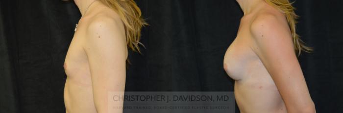Gender Confirmation or Transgender Surgery Case 137 Before & After Left Side | Boston, MA | Christopher J. Davidson, MD