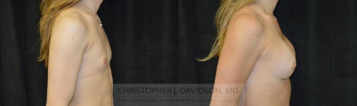 Gender Confirmation or Transgender Surgery Case 137 Before & After Right Side | Boston, MA | Christopher J. Davidson, MD