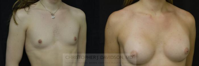 Gender Confirmation or Transgender Surgery Case 137 Before & After View #2 | Boston, MA | Christopher J. Davidson, MD