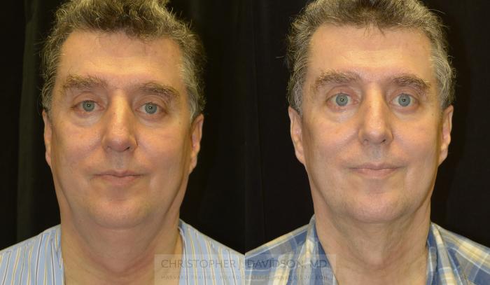 Kybella® for Double Chins Case 140 Before & After View #1 | Boston, MA | Christopher J. Davidson, MD