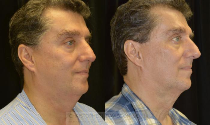 Kybella® for Double Chins Case 140 Before & After View #2 | Boston, MA | Christopher J. Davidson, MD