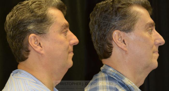 Kybella® for Double Chins Case 140 Before & After View #3 | Boston, MA | Christopher J. Davidson, MD